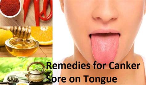 remedies-for-canker-sore-on-tongue