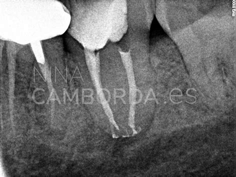 Deltas apicales - Nina Camborda - Endodoncista