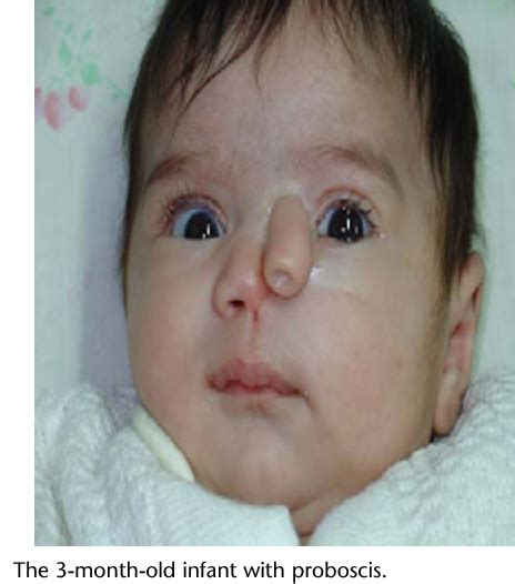 Figure 1 from Heminasal proboscis, a rare craniofacial cleft. - Semantic Scholar