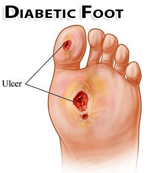 Diabetic Foot Care St. Catharines Ontario, Canadian Foot Clinic & Orthotic Centre