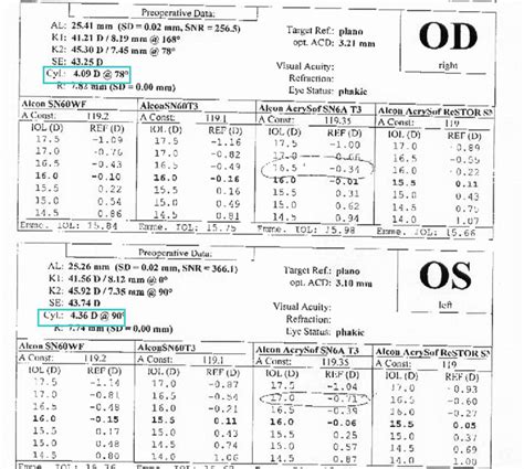 Toric Lens IOL exchange :: The University of Iowa, Ophthalmology