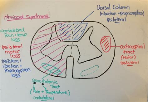 A Boring guide to Spinal Cord Syndromes - CanadiEM