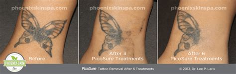 Experience PicoSure Tattoo Removal At - Phoenix Skin Spa