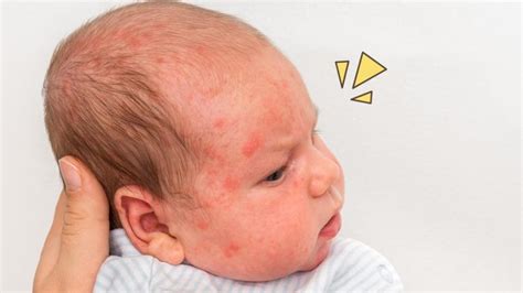 Symptoms And Pictures of Baby Allergic Reaction Rash