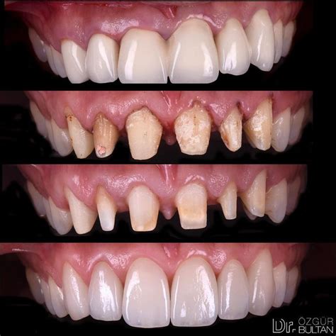 Splinted zirconia crowns were replaced with IPS e.max restorations ...