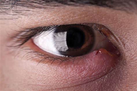 Bump on the Eyelid: Types, Symptoms, Causes, Treatment