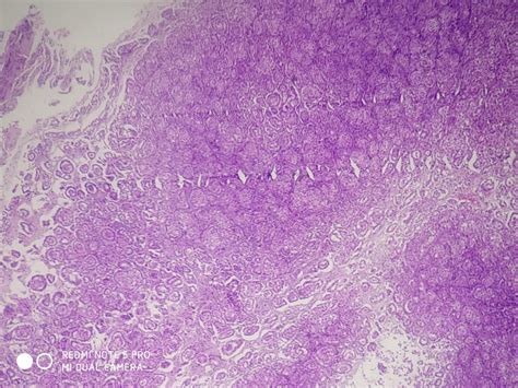 EPITHELIAL MALIGNANT MESOTHELIOMA – Histopathology.guru