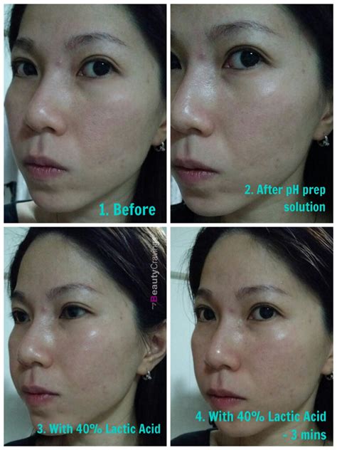 Review - At-Home 40% Lactic Acid Peel (MUAC) » myBeautyCravings