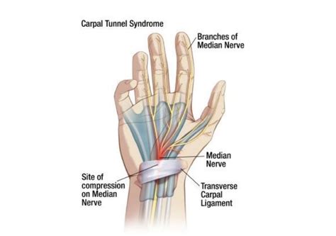 Tingling in Your Fingers? Is it Carpal Tunnel or Something Else? - Sheltering Arms®