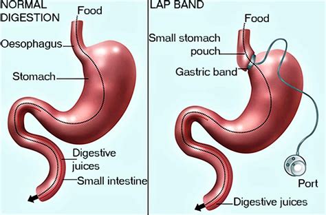 Lap band surgery, requirements, recovery time, risks, side effects & diet