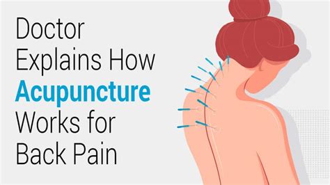 How Acupuncture Actually Works for Back Pain? A Doctor Explains