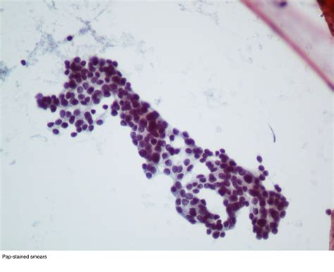 Pathology Outlines - Neuroendocrine neoplasms-general