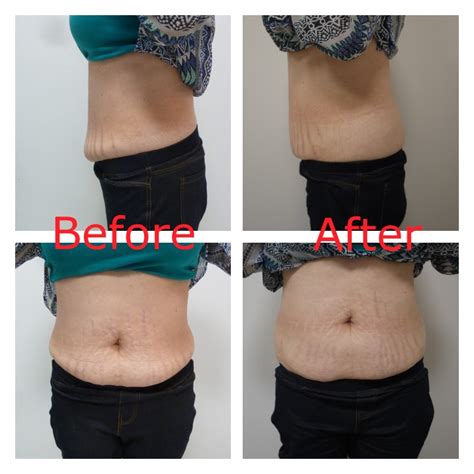 vanquish fat removal at home - yourcharm3dlife