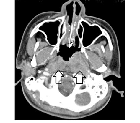 Rosenmuller Fossa Anatomy Diagram