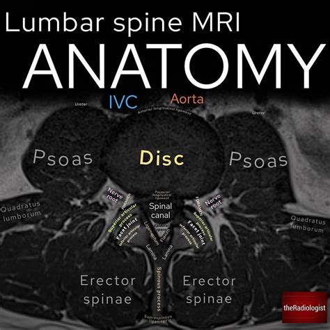 Axial Lumbar Mri Anatomy