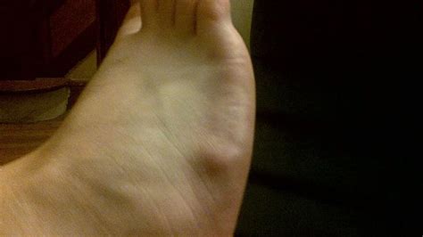 Is This A Cyst On My Foot? How Do I Treat It? - Cherrywood Foot Care