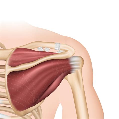 Tendinopathies - L'épaule au TOP