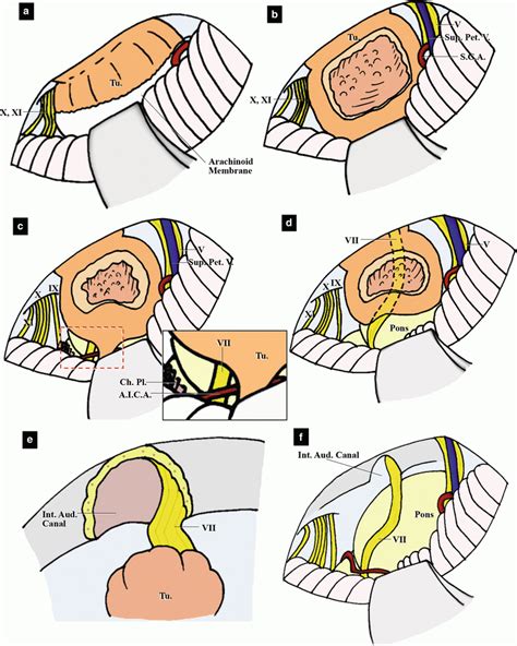 Microsurgical Anatomy of the Internal Auditory Canal and Surrounding Structures and Vestibular ...