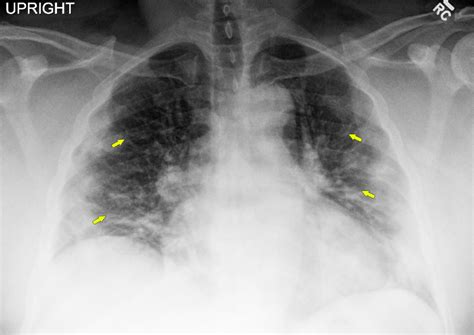 Cureus | Rhabdomyolysis in a Patient With Coronavirus Disease 2019