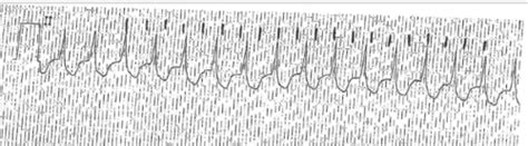 CV: EKGs/Rhythm strip practice for Exam 1 Flashcards | Quizlet