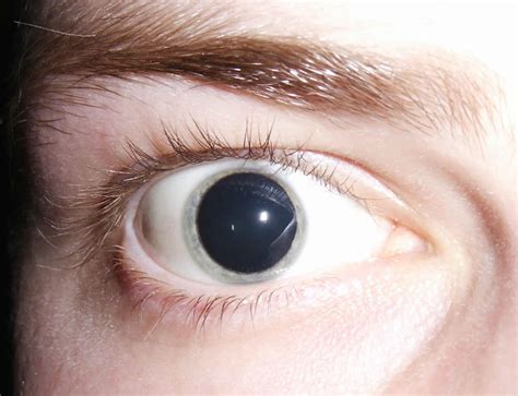 Mydriasis, mydriatic pupil causes, diagnosis & treatment