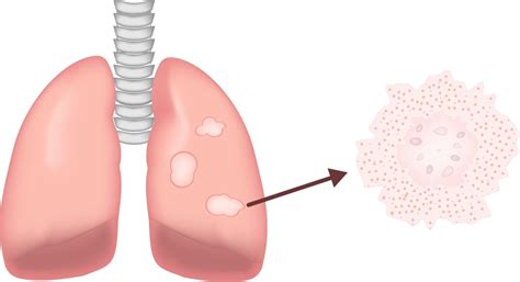 Sarcoidosis - Skin and Lungs - Symptoms | familydoctor.org