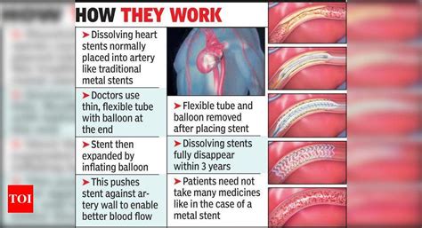 Use of dissolving heart stents now becoming commonplace | Nagpur News ...