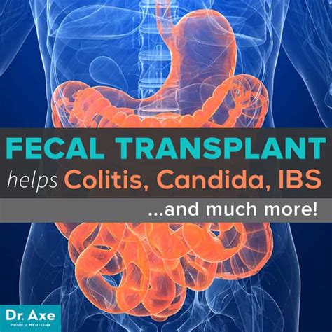 林榮茂部落格: The Fecal Transplant: Can It Help Colitis, Candida, IBS and More?