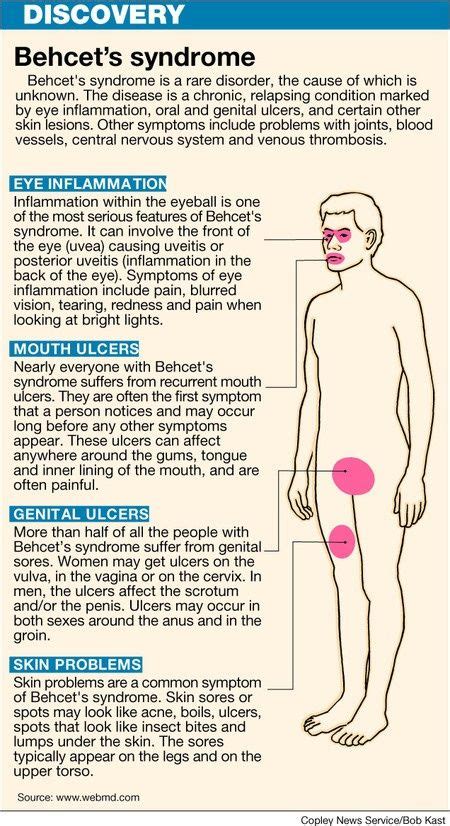 Behcet's Syndrome | Behcets syndrome, Behcets, Behcets disease