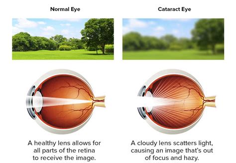 A cataract is a clouding of the normally clear human lens. Read more about it here: http ...