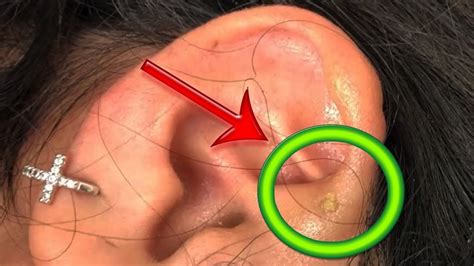 Popping Pimple In Ear Video - Subarubaruk