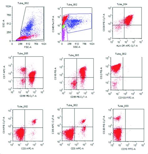 | The flow cytometry detection of bone marrow revealed CD3-CD56+ cells ...