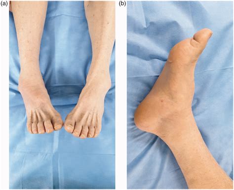 Gross (a) anteroposterior and (b) lateral photographs show a large bony ...