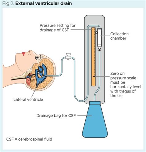 External Ventricular Drain Management