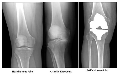 Total Knee Replacement - Knee Replacement - Knee Surgery