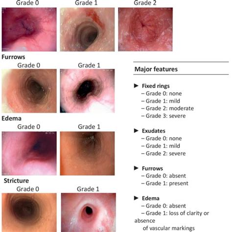 (PDF) The role of endoscopy in Eosinophilic Esophagitis: From diagnosis ...