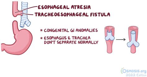 Rare Disease Education: Esophageal Atresia & Tracheoesophageal Fistula | Sustainable Development ...