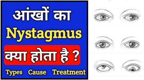 What Are The Different Types Of Nystagmus Treatment - vrogue.co