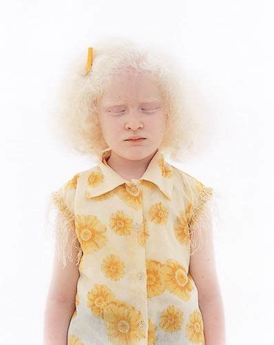 ARE WHITES ALBINO? - History Forum ~ All Empires - Page 1 Person With Albinism, Modelo Albino ...