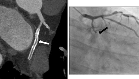 51-year-old patient with complete in-stent occlusion of left circumflex... | Download Scientific ...