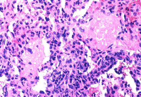 Pneumocystis jiroveci infection | Alveolar foamy exudate and… | Flickr