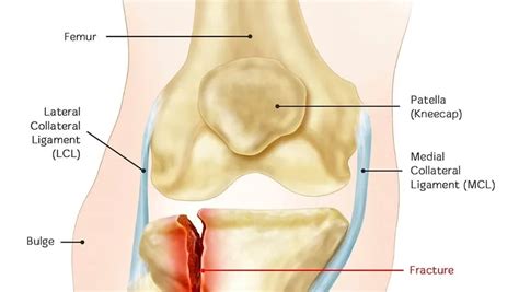 Proximal Tibia/Fibula Fracture - Carolina Regional Orthopedics