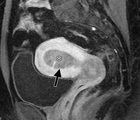 FIGO Staging System for Endometrial Cancer: Added Benefits of MR ...