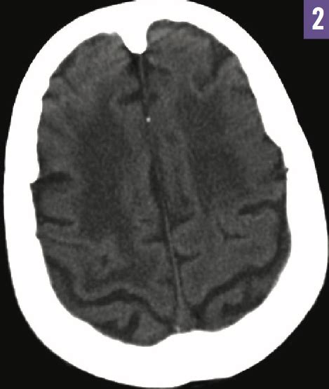 Dabigatran Reversal With Idarucizumab | Consultant360