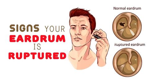 8 Signs Your Eardrum is Ruptured - YouTube