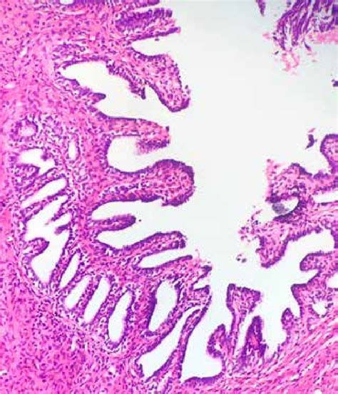 Histopathological apperance of Müllerian duct remnants. Micropapillary... | Download Scientific ...