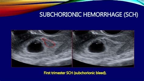 First trimester ultrasound Dr. Muhammad Bin Zulfiqar