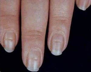 Healthwise: Ridges In your Nails ...