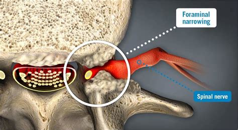 Foraminal Narrowing - USA Spine Care - Laser Spine Surgery