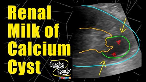 Milk Of Calcium Kidney Ultrasound